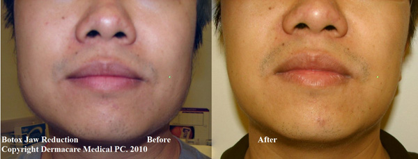 botox jaw muscle reduction male