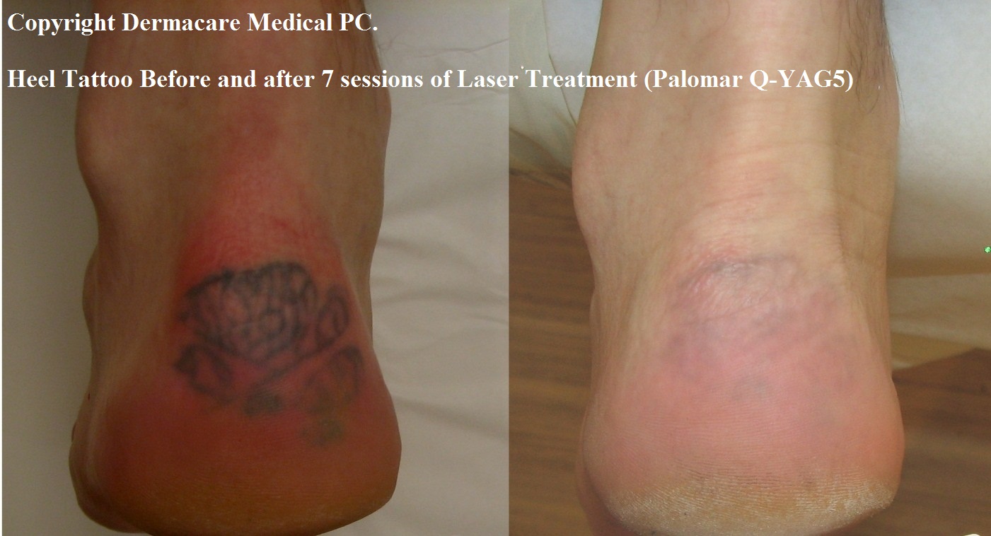 Tattoo Removal Prices on Pinterest | Tattoo Removal, Natural Tattoo ...