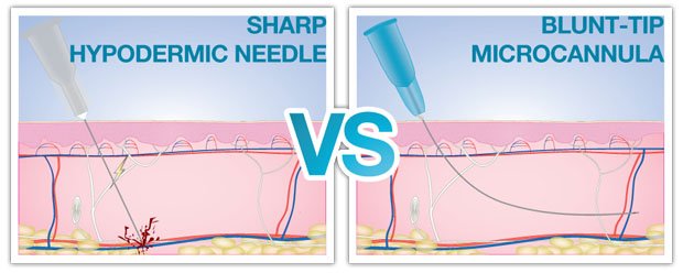 Image result for blunt tip cannula vs needle