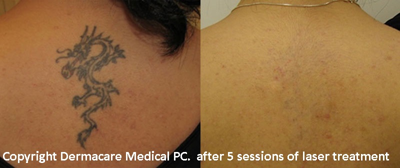 Who are not good candidates for a laser tattoo removal? *