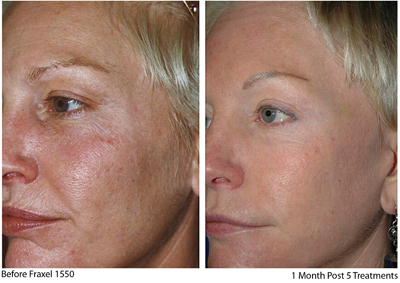 Fraxel re:store face before and after