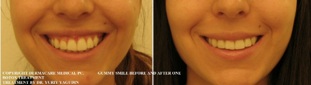 gummy smile before and after botox correction