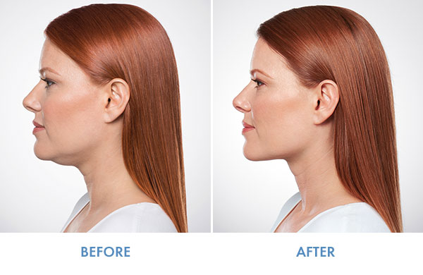 KYBELLA BEFORE AND AFTER