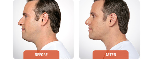 kybella male before and after