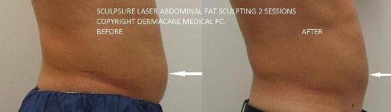sculpsure before and after