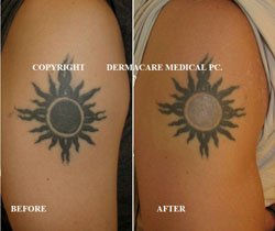 arm laser tattoo removal 