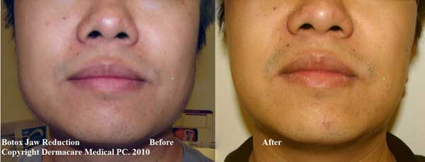 Botox jaw reduction before and after male