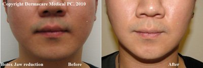 Botox jaw reduction in male before and after photo