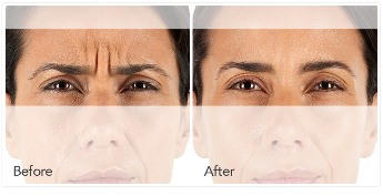 Xeomin before and after