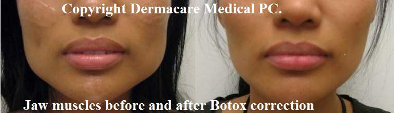 Botox jaw muscle reduction female