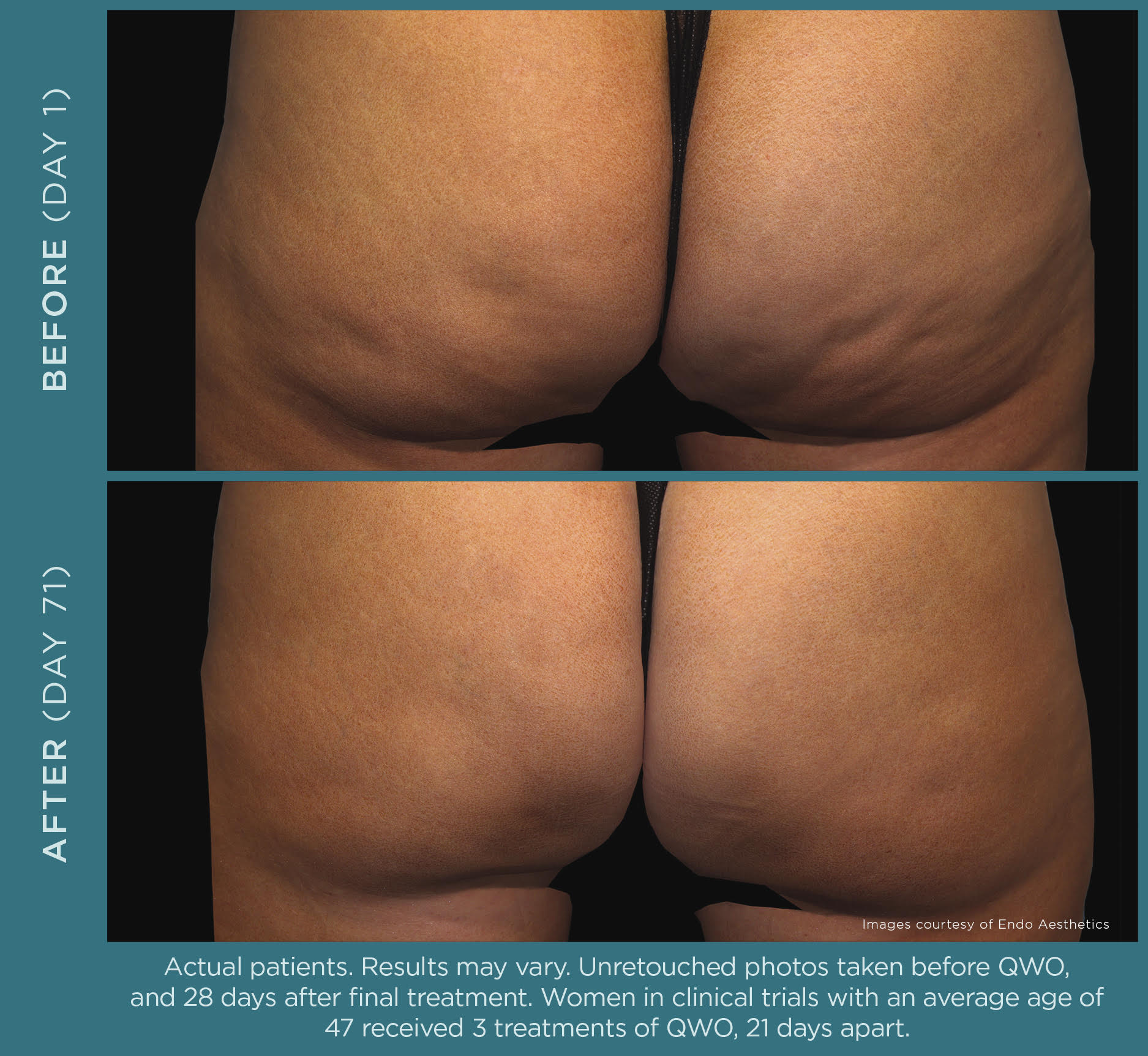 QWO cellulite treatment before and after