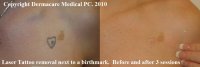 Chest tattoo removal
