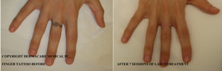 finger tattoo before and after laser treatment