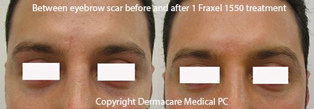 Fraxel scar treatment