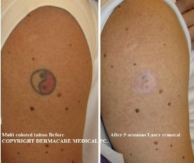 arm tattoo before after laser