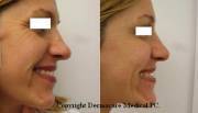 Crows feet botox before and after