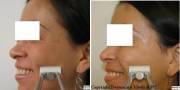 crows feet before and after botox