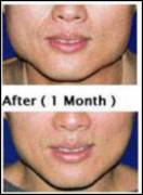 Botox jaw reduction