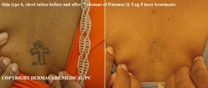 chest tatoo before and after laser treatment