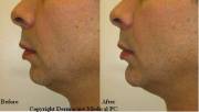 Chin augmentation before and after