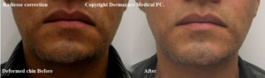 deformed chin correction with Radiesse