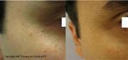Face Skin Tags removal before after