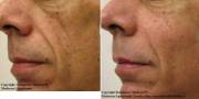 Facial Lipoatrophy before and after Radiesse correction 1