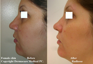 female chin before and after radiesse correction