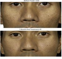fraxel acne scars before and after