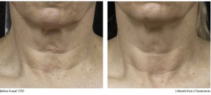 fraxel neck before and after