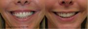 Gummy Smile Before and After Botox Treatment