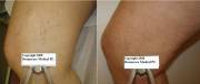 Before and After 2 Sessions Laser Vein Treatment