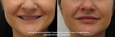 smiling lips before and after juvederm