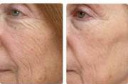 before and after laser resurfacing