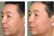 male before and after erbium laser resurfacing