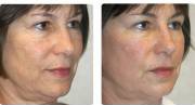 microlaser peel before and after 1 treatment