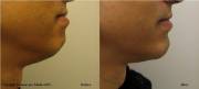 Non-surgical chin augmentation before and after