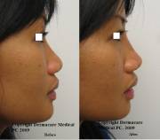 Non-surgical nose job with juvederm