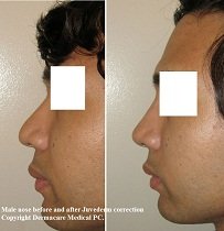 nose job before and after juvederm