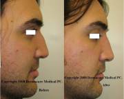 Nose humb correction with Juvederm