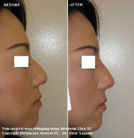 nose job non surgical picture before and after asian