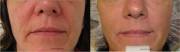 Non Surgical Facelift with Radiesse