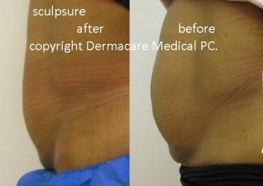 sculpsure after before