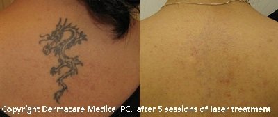 bacl laser tattoo removal