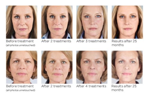 Sculptra face before and after